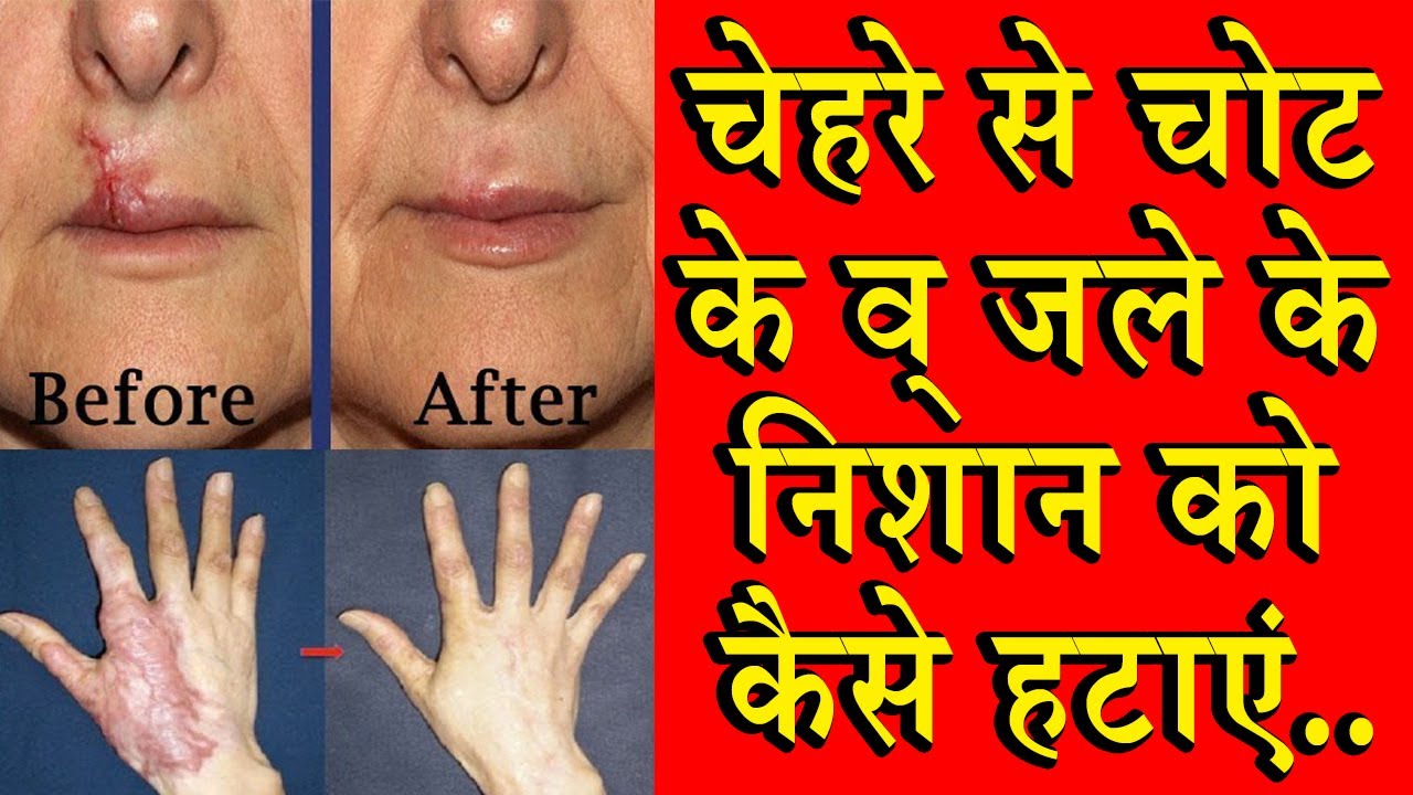  How To Remove Scars