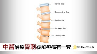 『骨刺』救星來了中醫治療『骨刺』緩解疼痛有一套| 談古論今 ... 