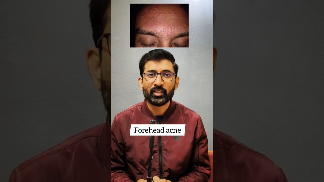 Forehead acne ! How to deal with it ? Skin care by Dr. Ketan Wagh 