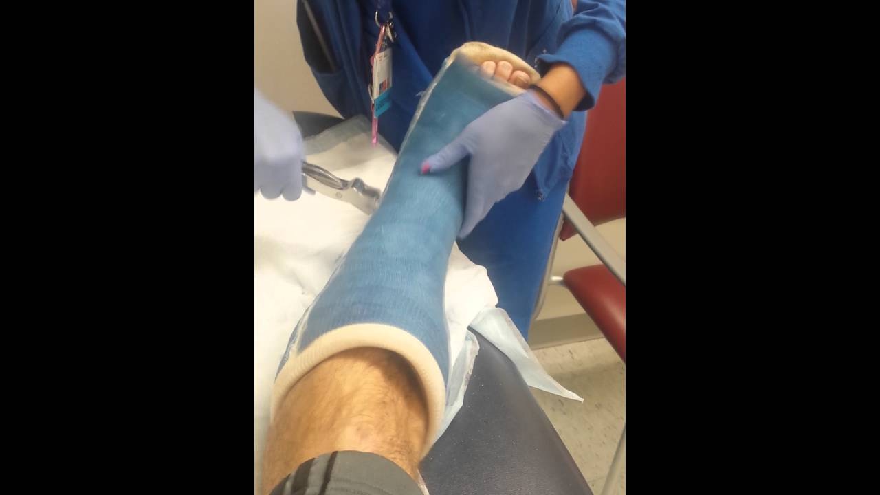 removal of first cast after 4 weeks YouTube