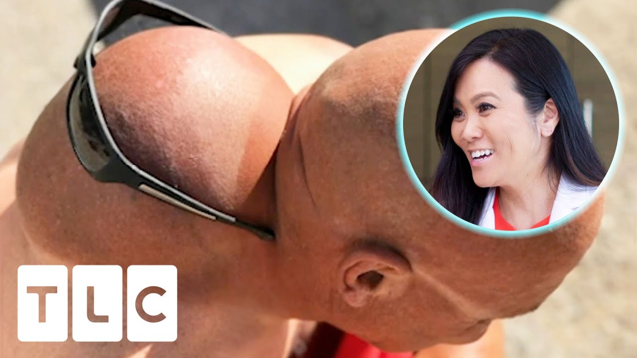 You A Head Behind Head!" | Dr. Pimple Popper: Before The Pop -