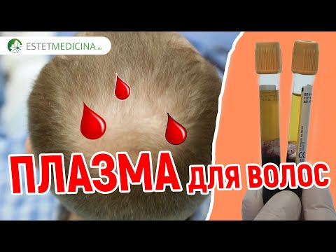 ПЛАЗМОЛИФТИНГ ВОЛОС. 💉💉💉 Процедура при выпадении волос. PRP для волос. ЛЕЧИМ ВОЛОСЫ ПЛАЗМОЙ