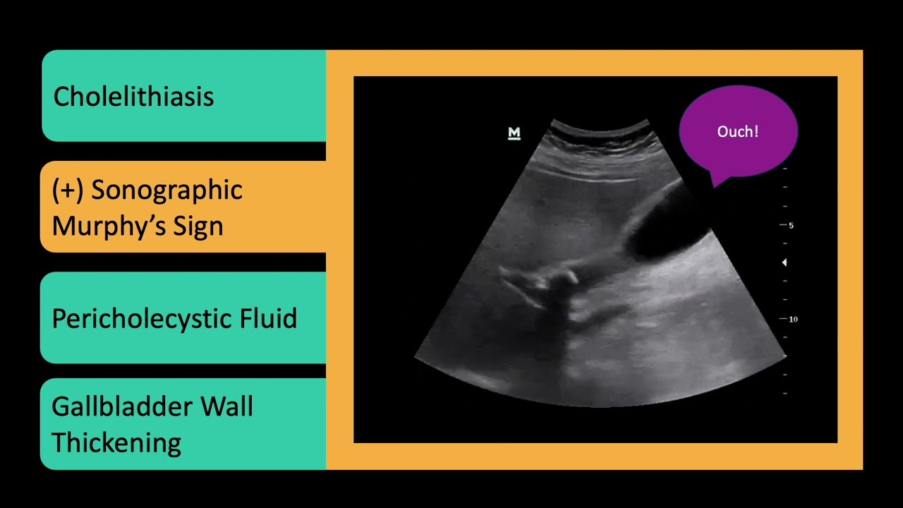 Gallbladder & Biliary POCUS | Scan for Stones, Cholecystitis & Duct Dilation