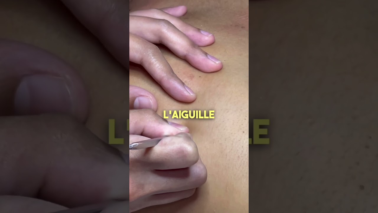 J'ai essayé un traitement contre l'acné du dos avec des lumières rouges! 