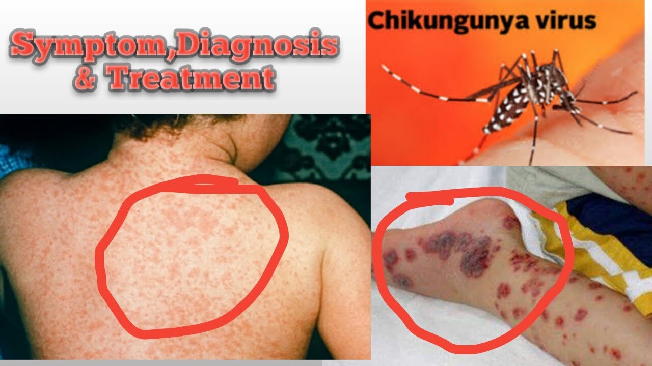 Image result for chikungunya symptoms