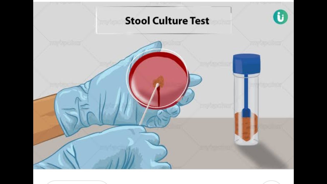 Stool for occult blood test in hindi part 2 YouTube