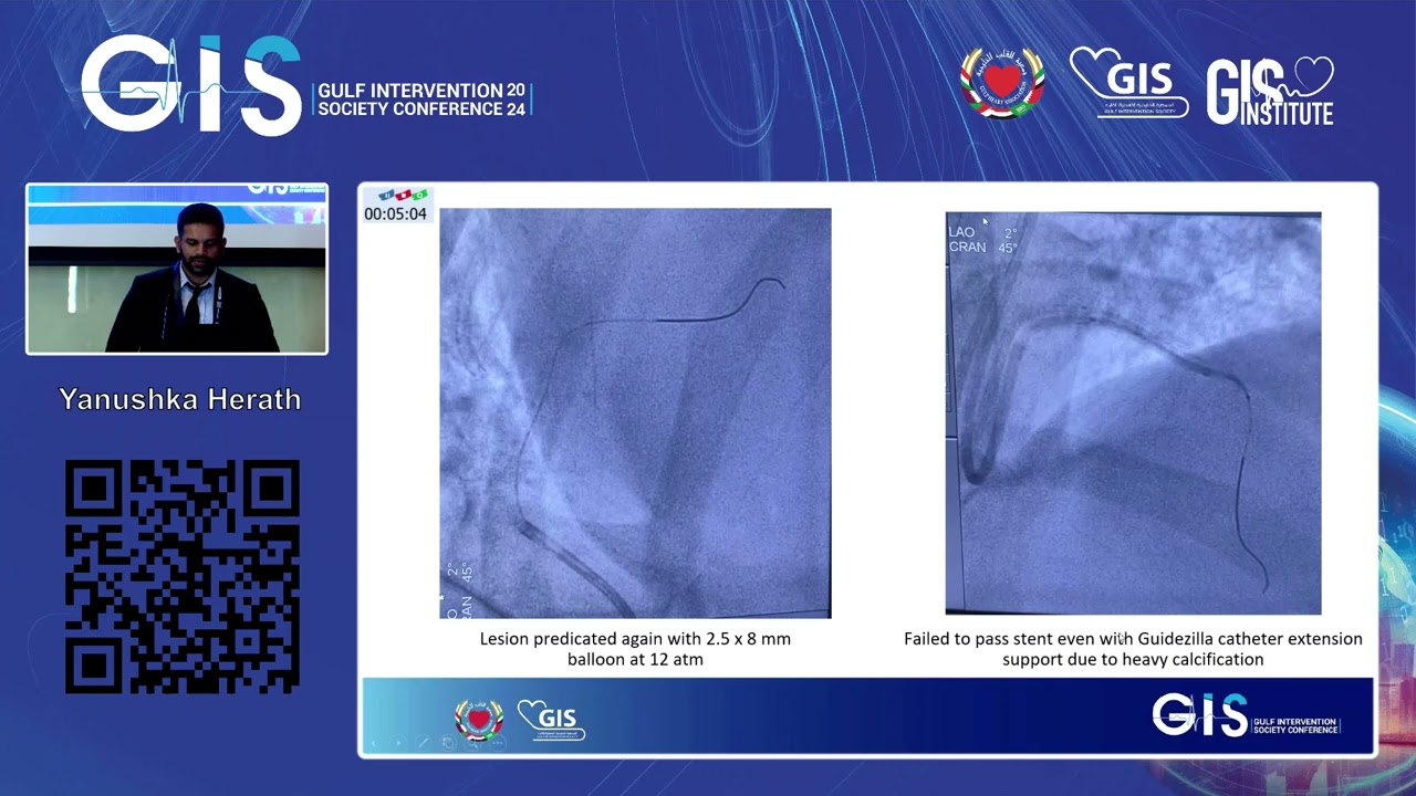 Yanushka Herath - Case of Le Main Coronary Artery Dissection   Guide Extension Induced