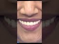Full mouth Dental Implants-makeover #bestdentalimplants #bestdentistbangalore