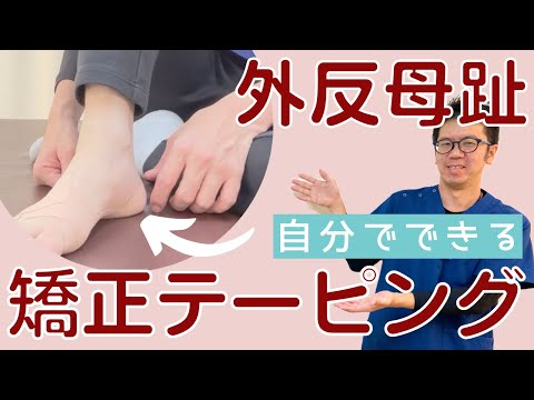 外反母趾を改善する矯正テーピング｜靴を履いた時の痛みを自分で改善する方法｜今治市　星野鍼灸接骨院