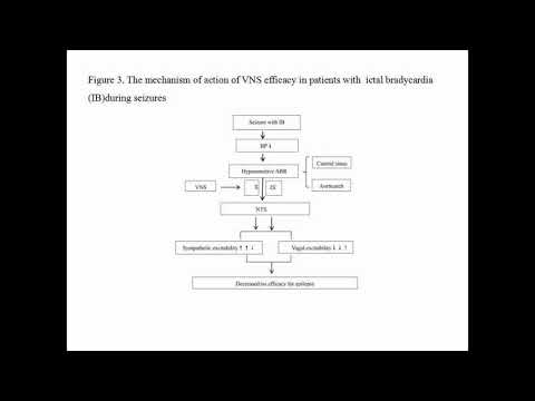 Ictal heart rate and effects of vagus stimulation in refractory epilepsy - Video Abstract ID 142714