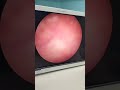 Urethral Tumor Section Surgery | Dr. Ankit Gupta | Urologist | Kidney Transplant Surgeon |