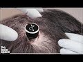 Neuralink Begins Human Testing!