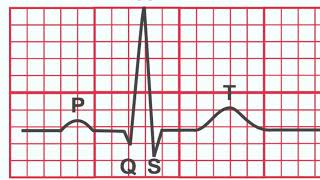 Normal EKG vs. Heart Attack