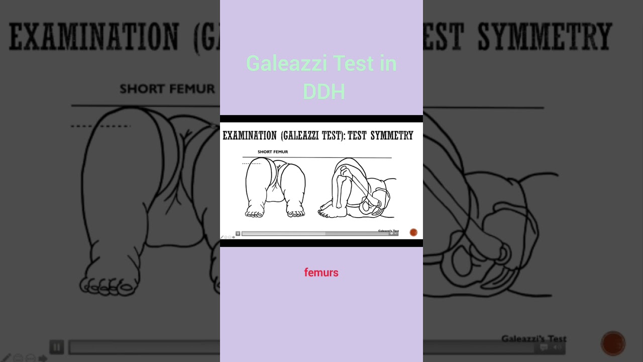 Galeazzi Test in DDH      