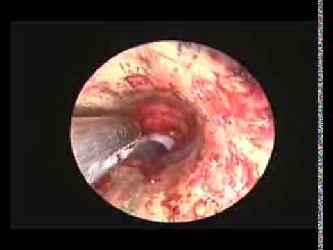 Implante de stent no br&ocirc;nquio-fonte direito