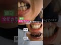 即日全歯の今井です和歌山からのモニター様 全ての歯のセラミック矯正担当させていただくことになりました。差し歯、銀歯、歯並び大阪前歯セラミック矯正専門ダイヤモンド今井院長#セラミック#セラミック矯正
