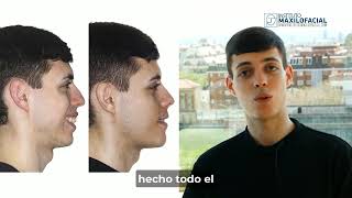 Cirugía Bimaxilar Caso Joaquin - Retrusión Maxilo-Mandibular, Apnea Del Sueño