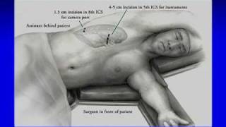 Part 1 of 3 VATS Thoracoscopic Lobectomy