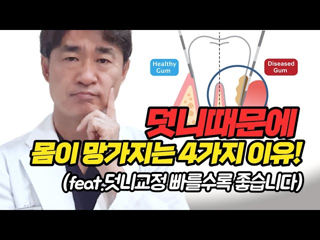 덧니때문에 몸이 망가지는 4가지 이유! feat.덧니교정, 빠를수록 좋습니다