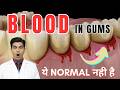 मसूड़ों से खून आना NORMAL नहीं है! पायरिया के लक्षण और इलाज