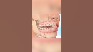 Giai đoạn xấu nhất khi niềng răng | Nha Khoa Vidental #nhakhoa #shorts #fyp #xuhuong #vidental