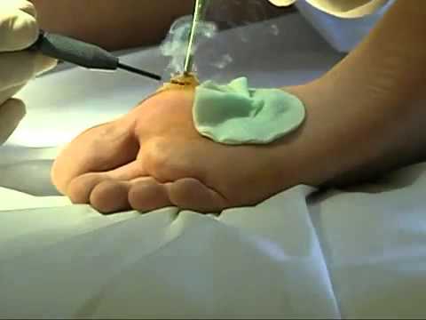 Сургитрон удаление бородавок