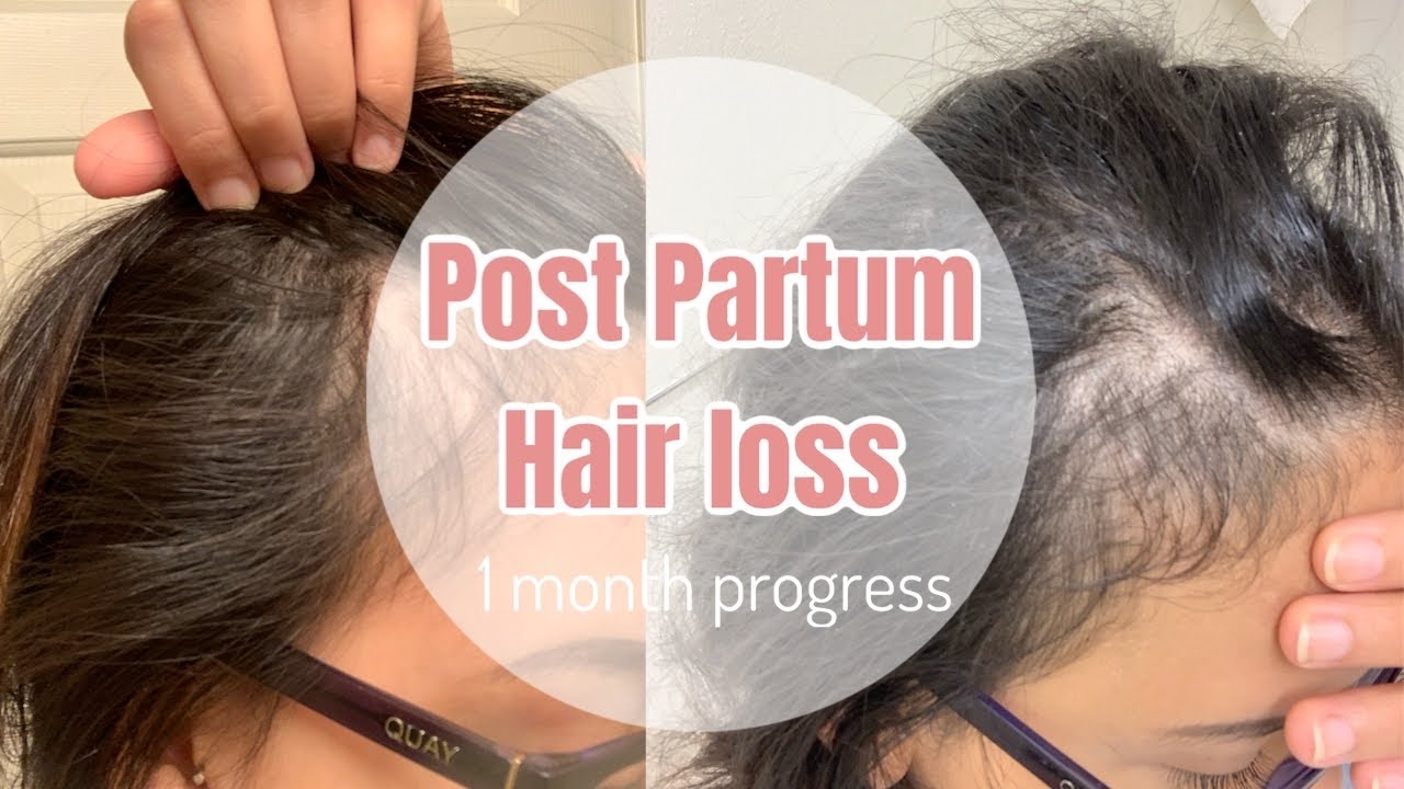 Postpartum Hair Loss Journey Part 1 Before And After One Month Youtube