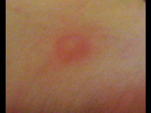 STRANGE ITCHY BUG BITES!!!!! - YouTube