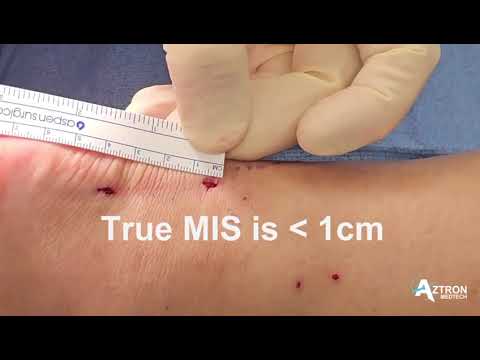 Real-Time Precision for Achilles Tendon Repair
