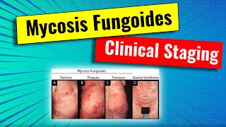 Staging of Mycosis fungoides (MF) : video series for dermatology residency and USMLE