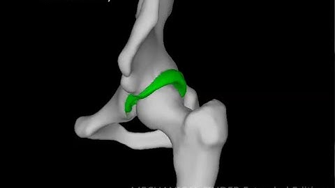 Quantitative CT-based Finite Element Analysis of Rotational Acetabular Osteotomy