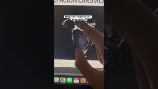 Ecocardiograma E Insuficiencia Mitral