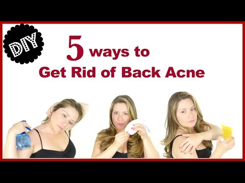 HOW TO GET RID OF BACK ACNE
