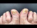 CUTTING TOENAILS WITH FUNGUS