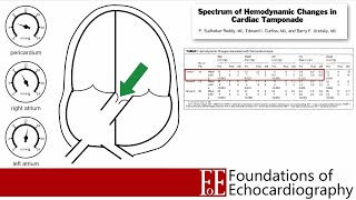 Level 1 Video Lecture: Pericardial Effusions and Cardiac Tamponade