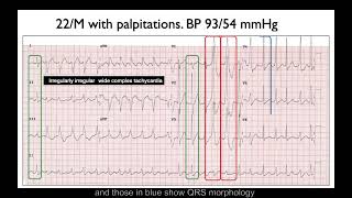 ECG in 60s - Irregularly irregular wide complex tachycardia