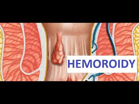 Video: Hemoroidy: Příznaky, Diagnostika A Léčba