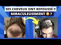 Calvitie  ses cheveux repoussent en 9 mois avec ce traitement 