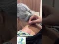 Acupuncture thrapy #viral #youtube