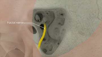 Phẫu thuật cấy ốc tai điện tử - Tai Mũi Họng Xuyên Á