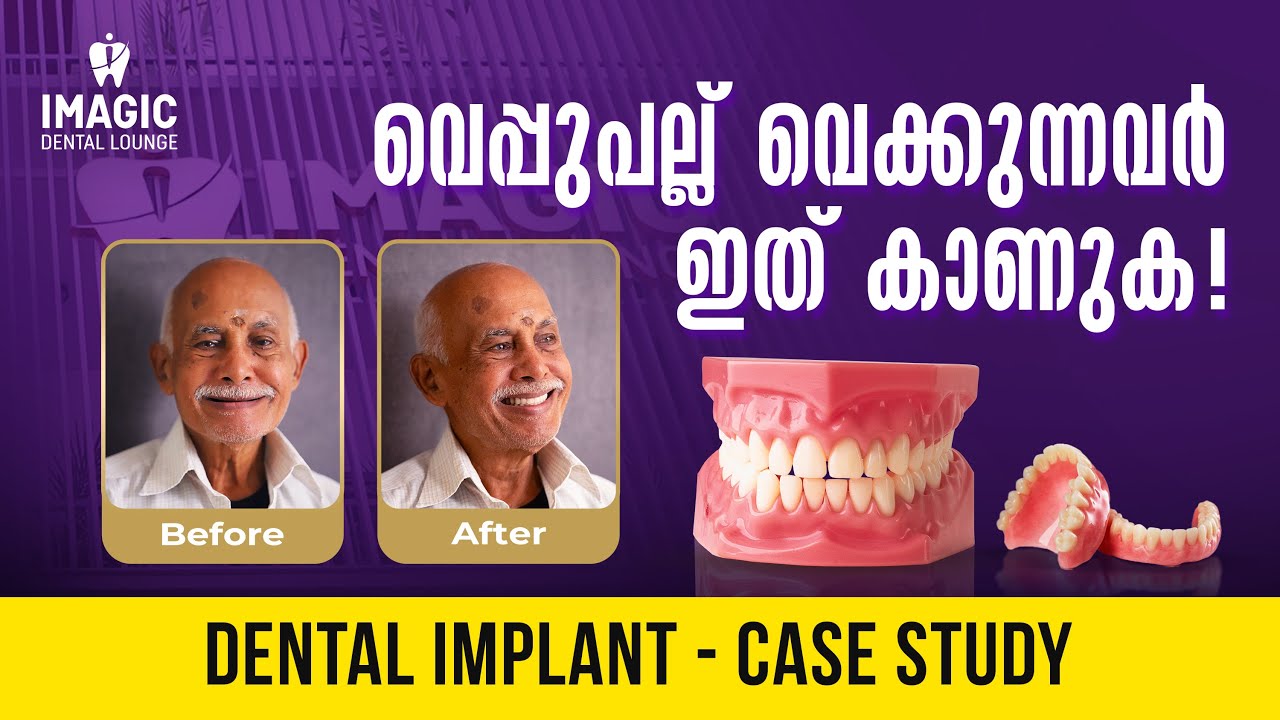 Dental Implant  ചെയ്യാൻ പോകുന്നവർ  അറിഞ്ഞിരിക്കേണ്ട കാര്യങ്ങൾ...