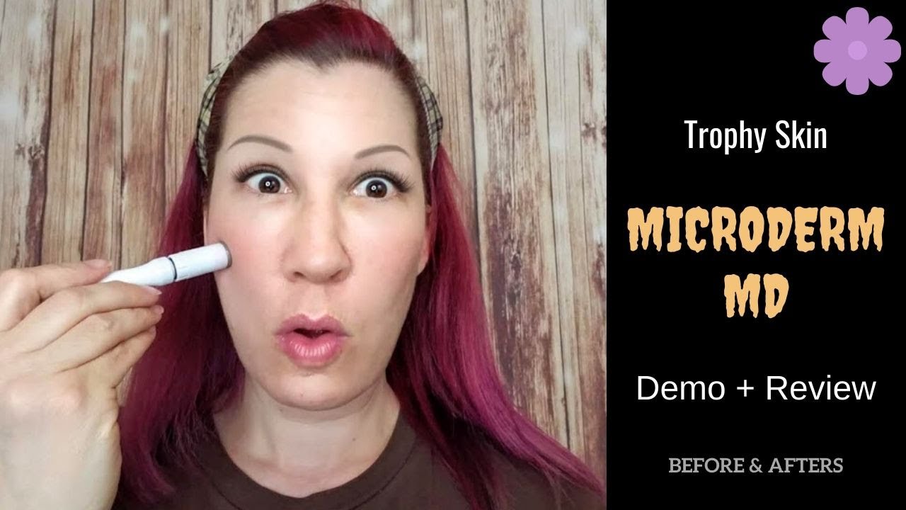 WHY I STOPPED USING TROPHY SKIN MICRODERMABRASION - MAKEUP FOR