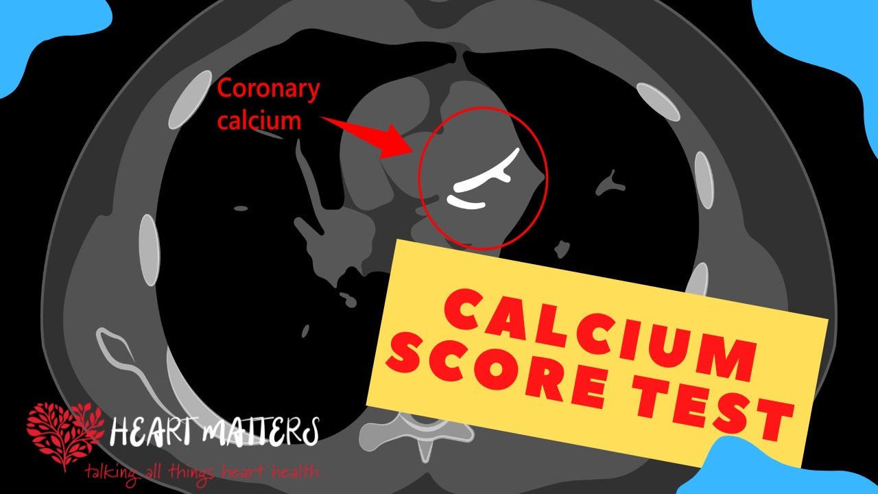 High Calcium Score: What's Next <br>for Your Heart Health? Heart Matters
