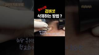 검버섯 삭제하는 방법이 있다고? #검버섯 #흑자 #어븀야그 #CO2 #리팟레이저 #엑셀브이