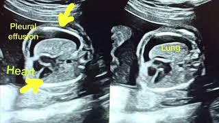 FETAL ISOLATED CHYLOTHORAX|| FETAL PLEURAL EFFUSION || ULTRASOUND OF THE HYDROPS FETALIS||DAILY RAD screenshot 2