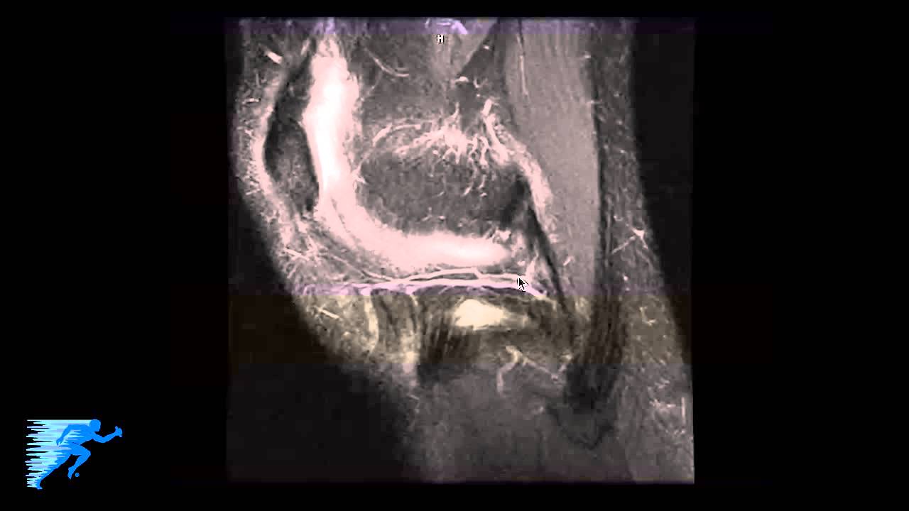 How to Read Knee MRI of MCL Injury | Complex Knee Surgeon | Colorado