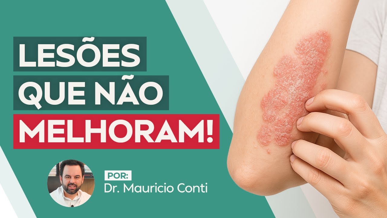 Como saber se eu tenho Psoríase? Diagnósticos e sintomas!