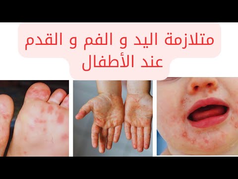 مرض اليد والفم والقدم عند الأطفال الأعراض و كيفية الوقاية و العلاج