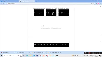 Detection of Cardiovascular Disease using ECG images in Machine Learning and Deep learning