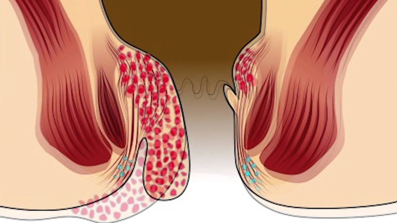 Геморрой Фото Людей